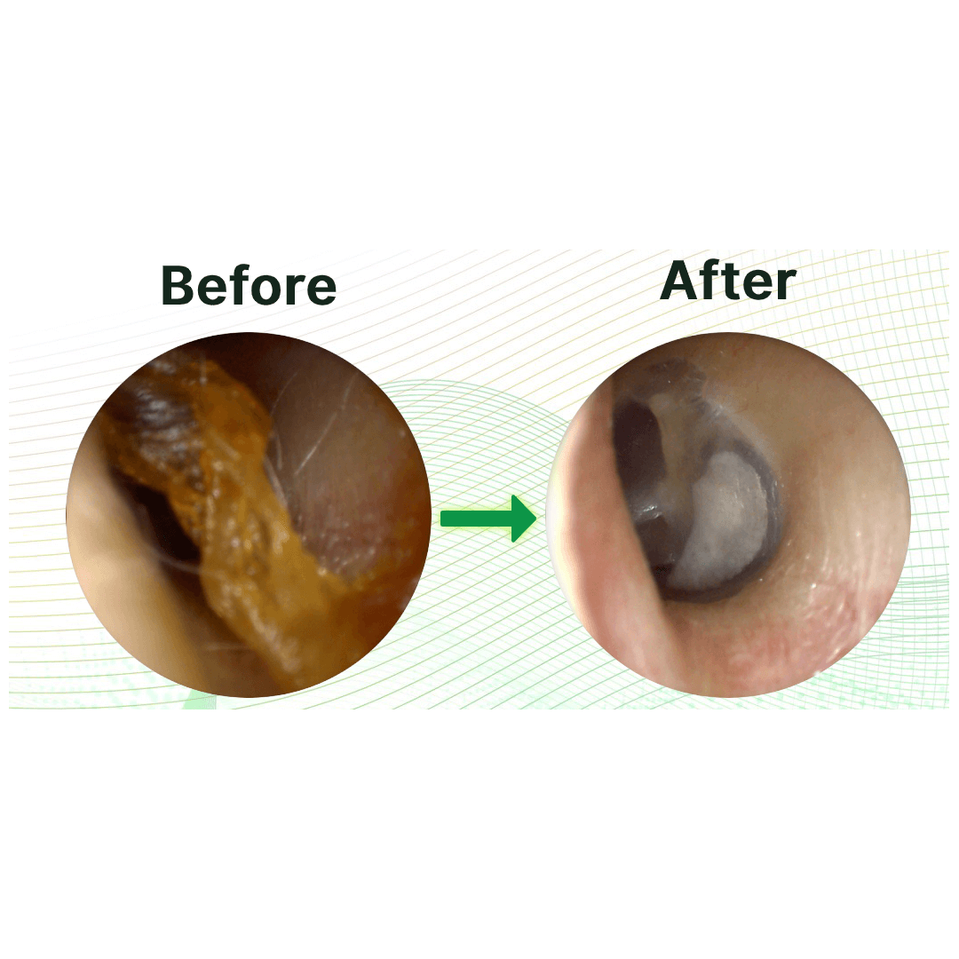 Hearix Visual Ear Cleaner