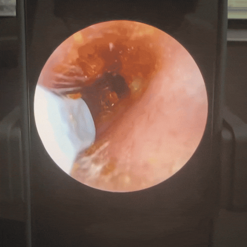Hearix Visual Ear Cleaner
