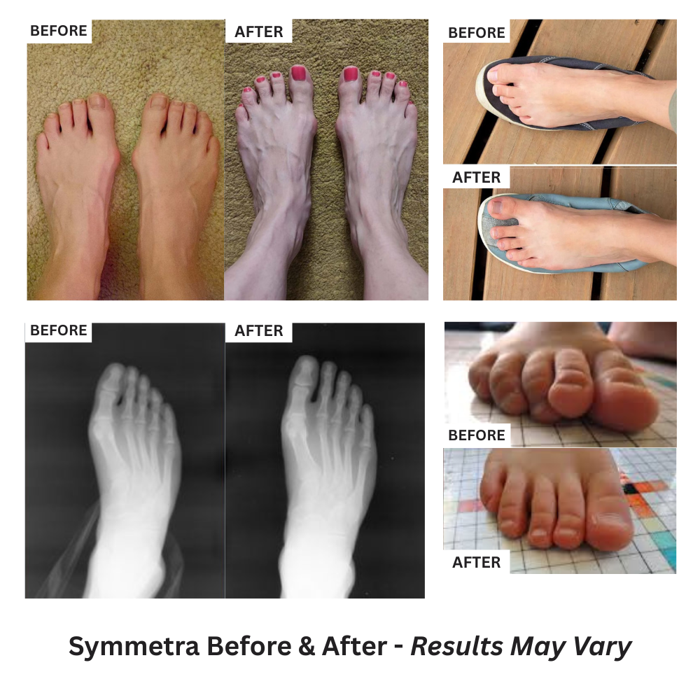 Symmetra Foot Realignment System